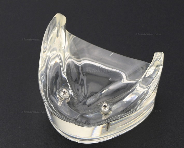 Dental Teeth Model Overdenture Inferior with 2 Implants Study Demo Model 6002 01
